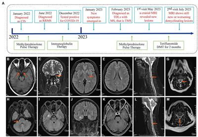 Frontiers Case Report A Novel Case Of Covid Triggered Tumefactive Demyelinating Lesions In